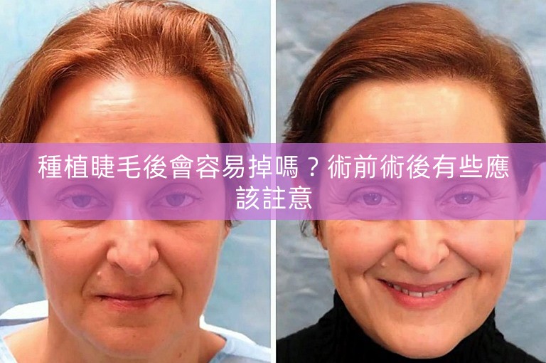 種植睫毛後會容易掉嗎？術前術後有些應該註意