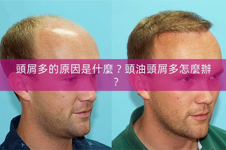 頭屑多的原因是什麼?頭油頭屑多怎麼辦? 頭屑多的原因是什麼?頭油頭屑多怎麼辦?