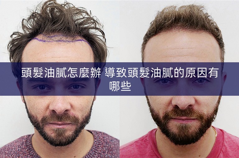 頭髮油膩怎麼辦 導致頭髮油膩的原因有哪些