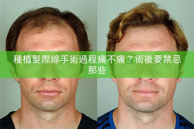 種植髮際線手術過程痛不痛？術後要禁忌那些