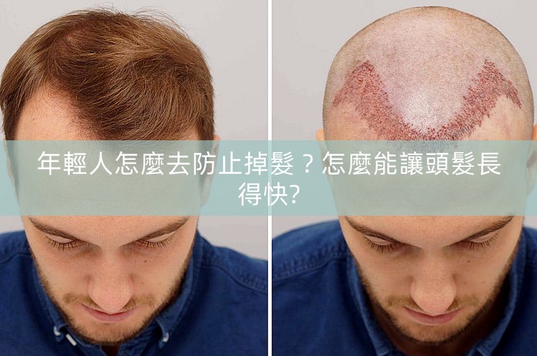 年輕人怎麼去防止掉髮？怎麼能讓頭髮長得快?