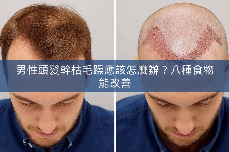 男性頭髮幹枯毛躁應該怎麼辦？八種食物能改善