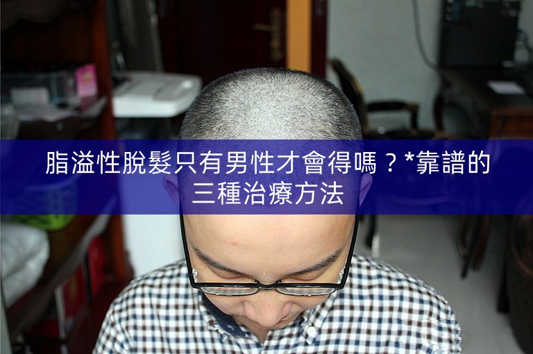 脂溢性脫髮只有男性才會得嗎？*靠譜的三種治療方法