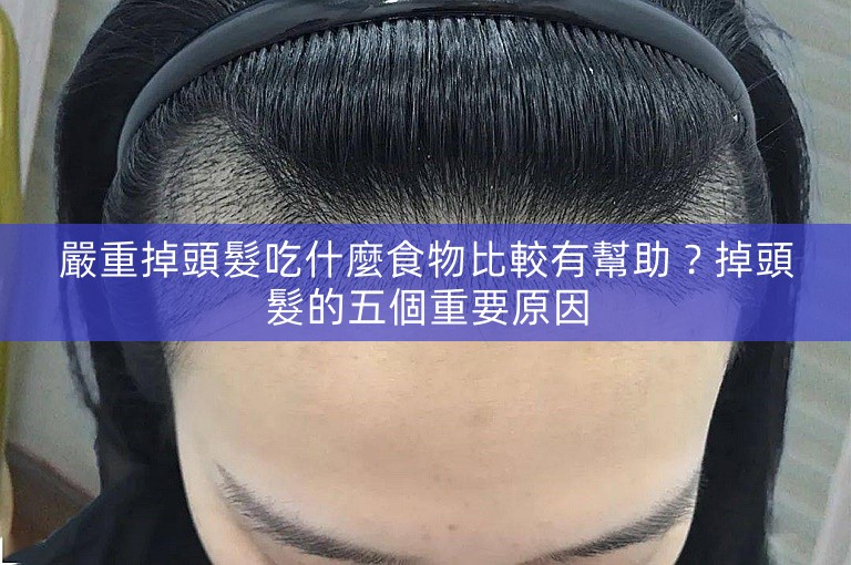嚴重掉頭髮吃什麼食物比較有幫助？掉頭髮的五個重要原因