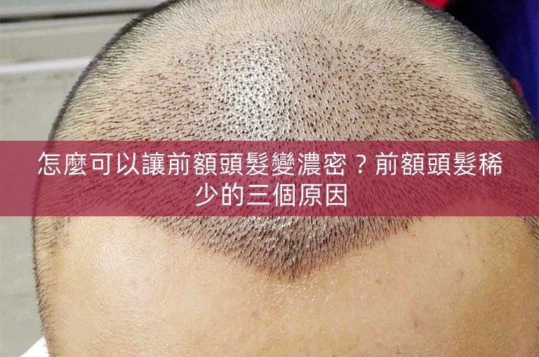 怎麼可以讓前額頭髮變濃密？前額頭髮稀少的三個原因