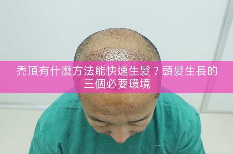 禿頂有什麼方法能快速生髮？頭髮生長的三個必要環境