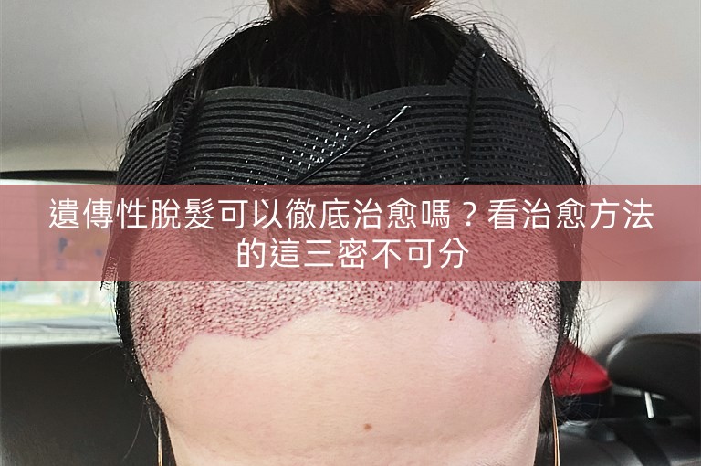 遺傳性脫髮可以徹底治愈嗎？看治愈方法的這三密不可分