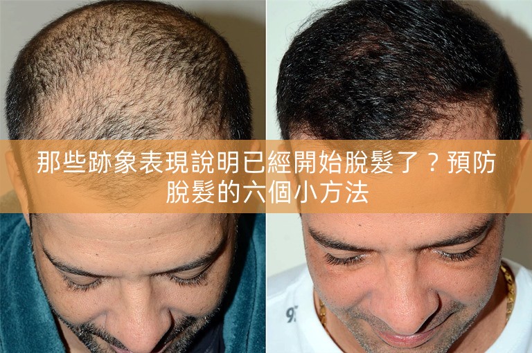 那些跡象表現說明已經開始脫髮了？預防脫髮的六個小方法