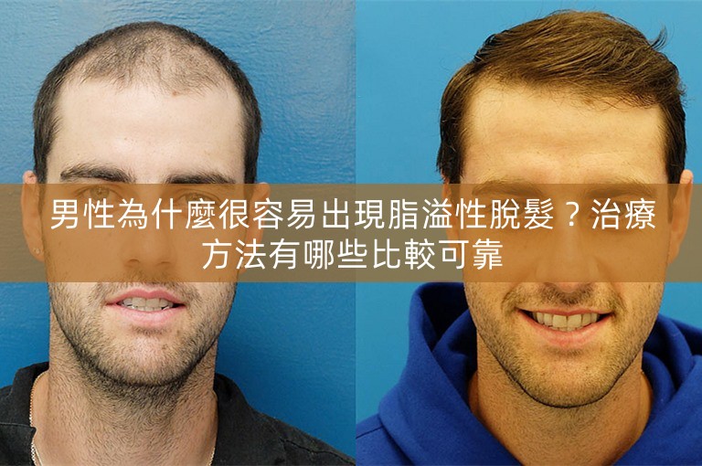 男性為什麼很容易出現脂溢性脫髮？治療方法有哪些比較可靠