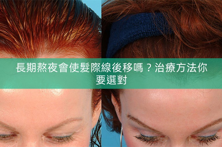 長期熬夜會使髮際線後移嗎？治療方法你要選對