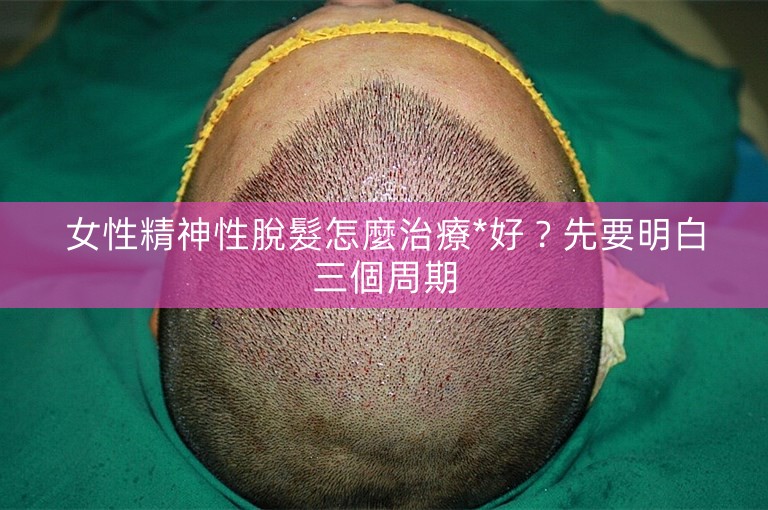 女性精神性脫髮怎麼治療*好？先要明白三個周期