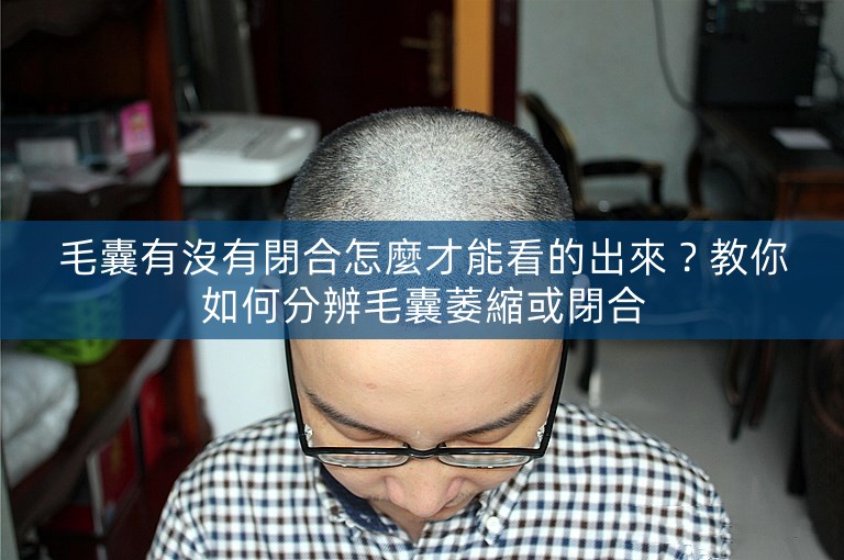 毛囊有沒有閉合怎麼才能看的出來？教你如何分辨毛囊萎縮或閉合