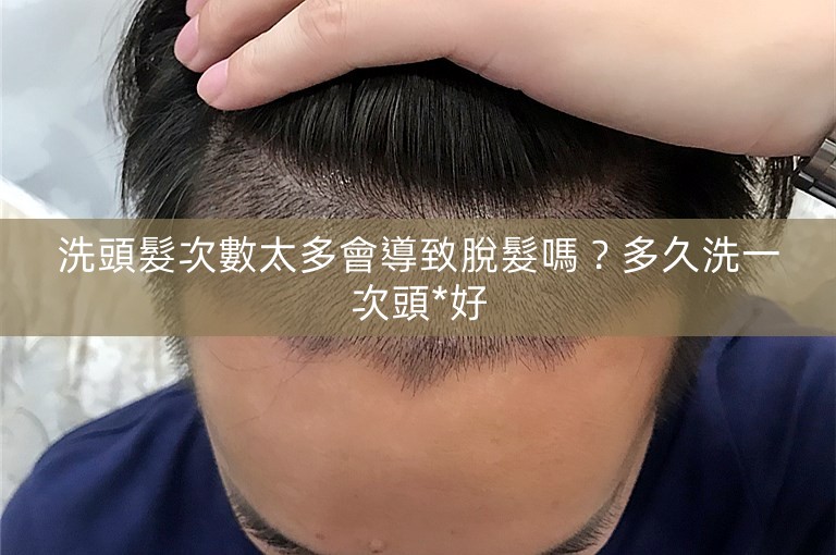 洗頭髮次數太多會導致脫髮嗎？多久洗一次頭*好