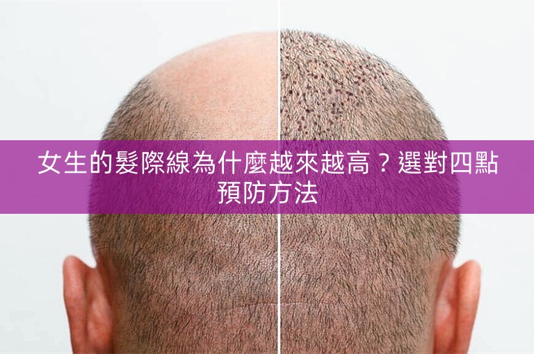 女生的髮際線為什麼越來越高？選對四點預防方法
