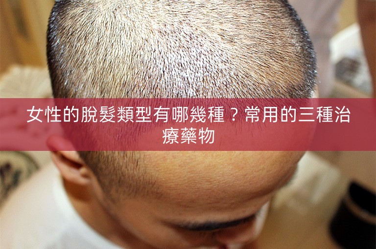 女性的脫髮類型有哪幾種?常用的三種治療藥物 女性的脫髮類型有哪幾種?常用的三種治療藥物