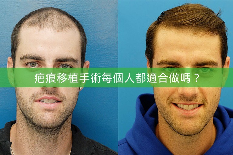 疤痕移植手術每個人都適合做嗎？