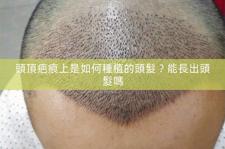 頭頂疤痕上是如何種植的頭髮？能長出頭髮嗎
