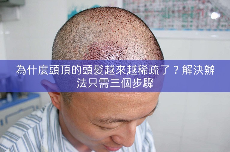 為什麼頭頂的頭髮越來越稀疏了？解決辦法只需三個步驟