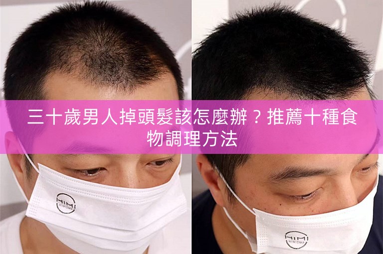 三十歲男人掉頭髮該怎麼辦？推薦十種食物調理方法