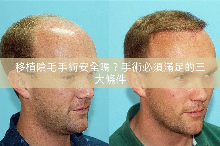 移植陰毛手術安全嗎？手術必須滿足的三大條件