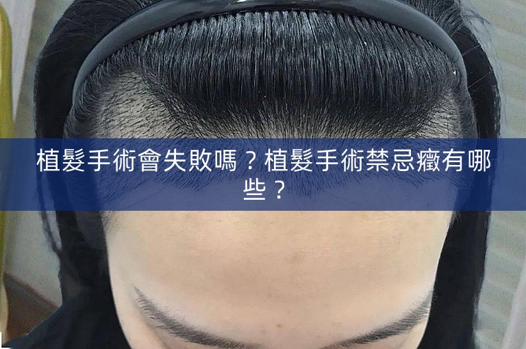 植髮手術會失敗嗎？植髮手術禁忌癥有哪些？