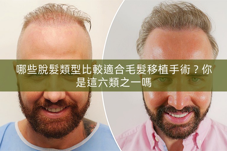 哪些脫髮類型比較適合毛髮移植手術？你是這六類之一嗎