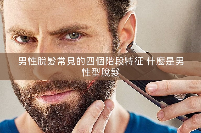 男性脫髮常見的四個階段特征 什麼是男性型脫髮