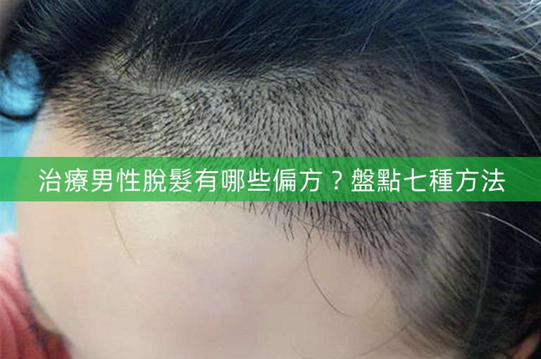 治療男性脫髮有哪些偏方？盤點七種方法