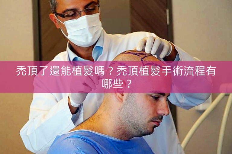 禿頂了還能植髮嗎？禿頂植髮手術流程有哪些？