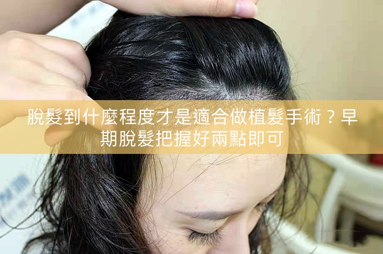 脫髮到什麼程度才是適合做植髮手術？早期脫髮把握好兩點即可