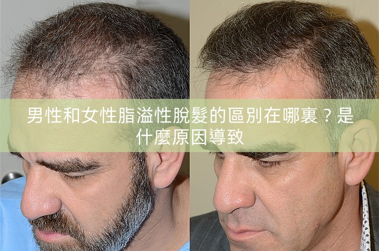 男性和女性脂溢性脫髮的區別在哪裏？是什麼原因導致