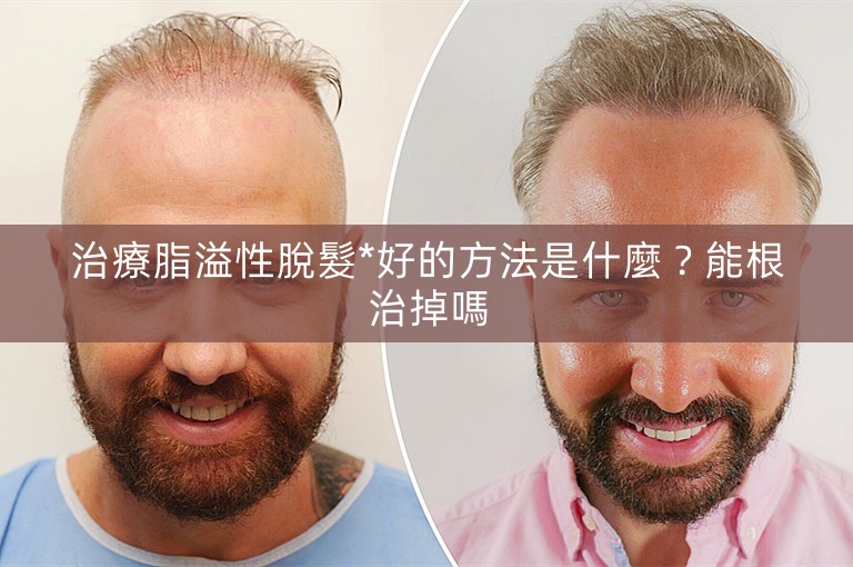 治療脂溢性脫髮*好的方法是什麼？能根治掉嗎