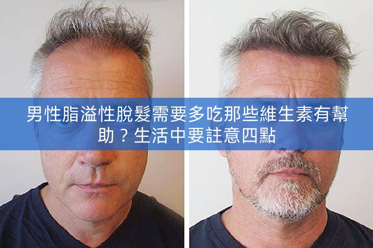 男性脂溢性脫髮需要多吃那些維生素有幫助？生活中要註意四點