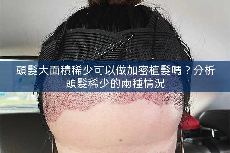 頭髮大面積稀少可以做加密植髮嗎？分析頭髮稀少的兩種情況