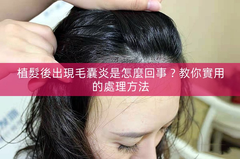 植髮後出現毛囊炎是怎麼回事？教你實用的處理方法