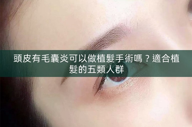 頭皮有毛囊炎可以做植髮手術嗎？適合植髮的五類人群
