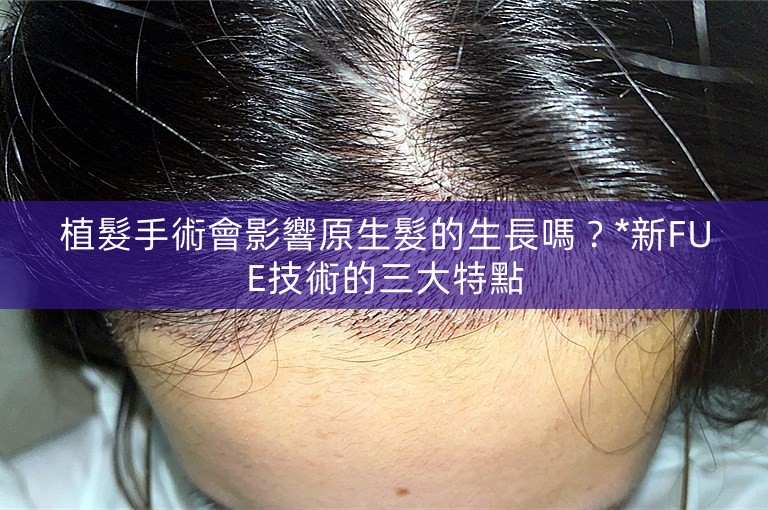 植髮手術會影響原生髮的生長嗎？*新FUE技術的三大特點