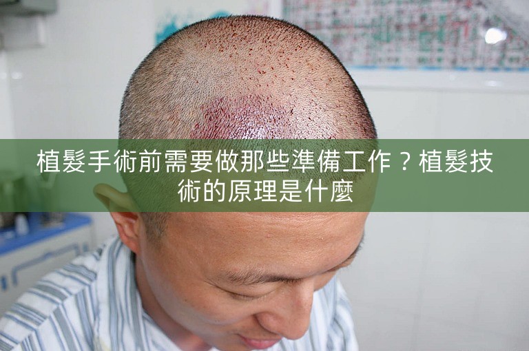 植髮手術前需要做那些準備工作？植髮技術的原理是什麼