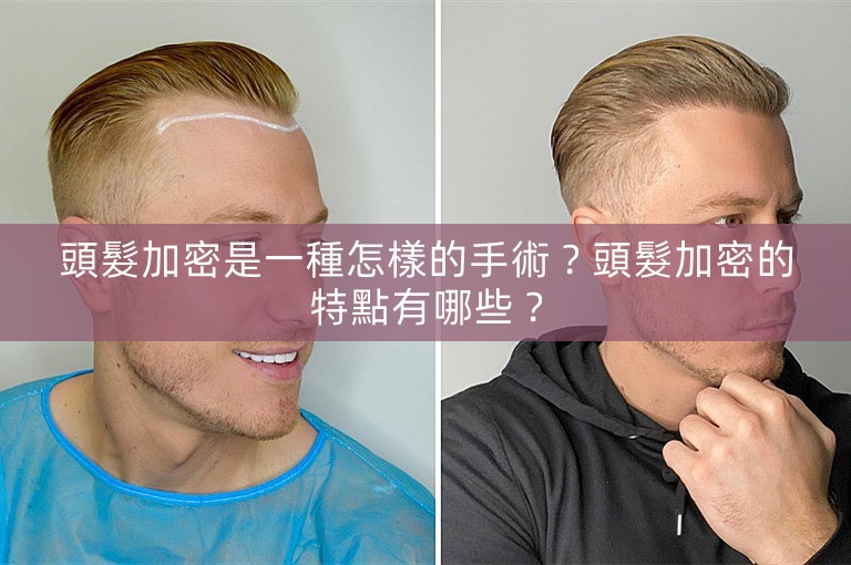 頭髮加密是一種怎樣的手術？頭髮加密的特點有哪些？