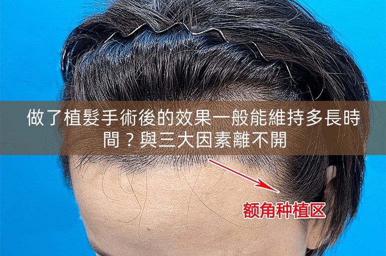 做了植髮手術後的效果一般能維持多長時間？與三大因素離不開