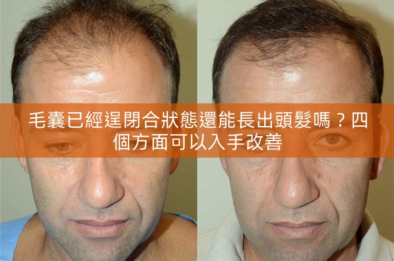 毛囊已經逞閉合狀態還能長出頭髮嗎？四個方面可以入手改善
