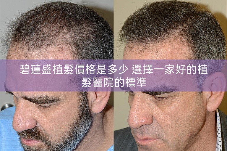 碧蓮盛植髮價格是多少 選擇一家好的植髮醫院的標準