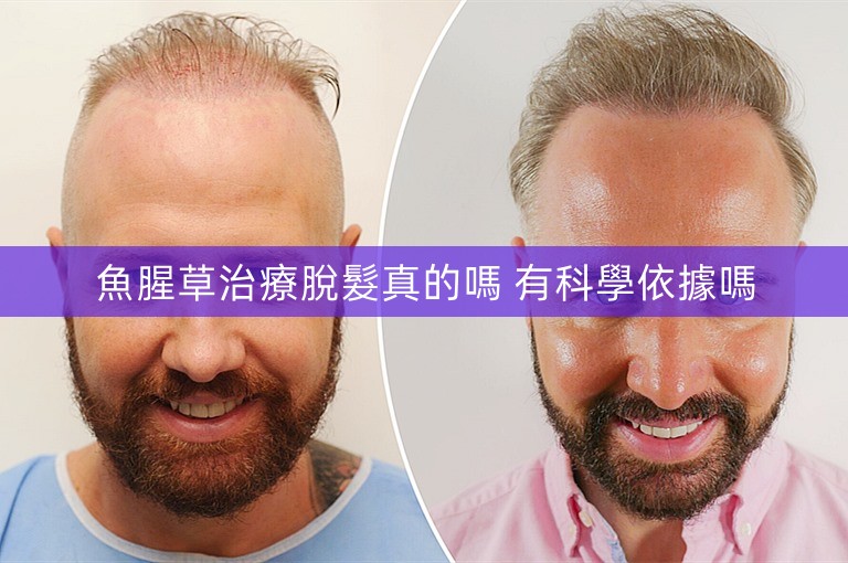 魚腥草治療脫髮真的嗎 有科學依據嗎