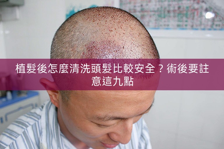植髮後怎麼清洗頭髮比較安全？術後要註意這九點