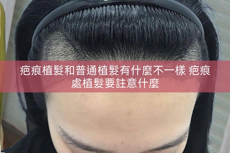 疤痕植髮和普通植髮有什麼不一樣 疤痕處植髮要註意什麼 疤痕植髮和普通植髮有什麼不一樣 疤痕處植髮要註意什麼