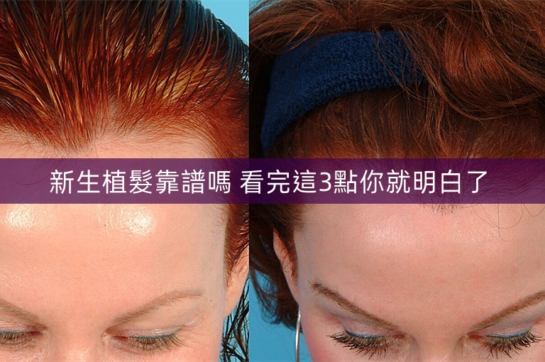 新生植髮靠譜嗎 看完這3點你就明白了 