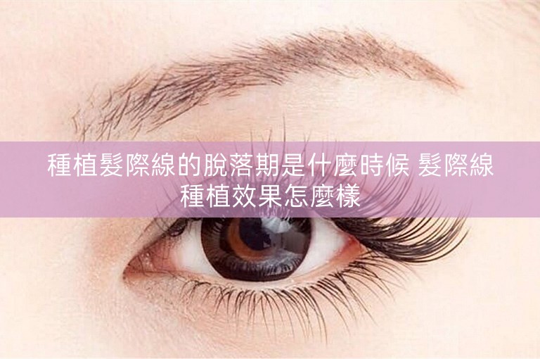 種植髮際線的脫落期是什麼時候 髮際線種植效果怎麼樣
