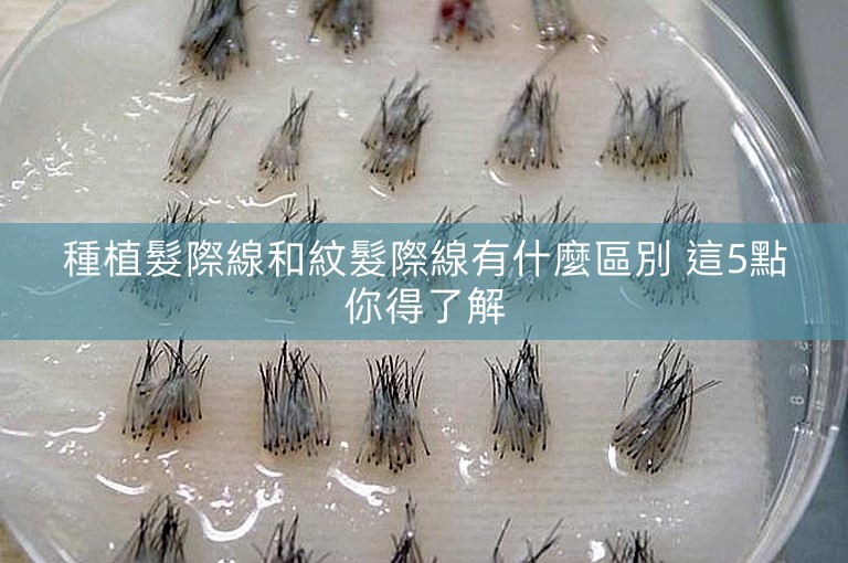 種植髮際線和紋髮際線有什麼區別 這5點你得了解