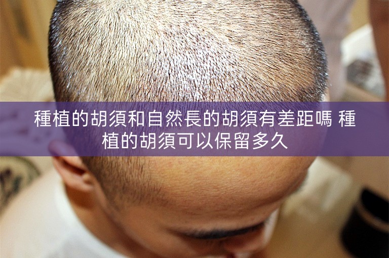 種植的胡須和自然長的胡須有差距嗎 種植的胡須可以保留多久