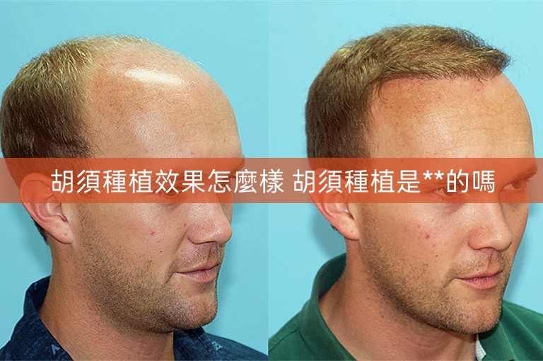 胡須種植效果怎麼樣 胡須種植是**的嗎